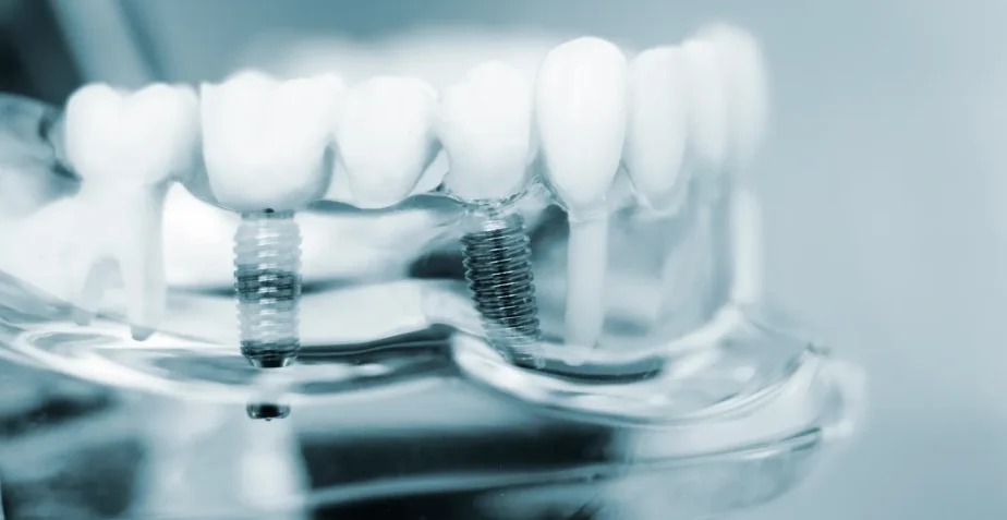 Dental Implant Courses | TCP Implant Marathon